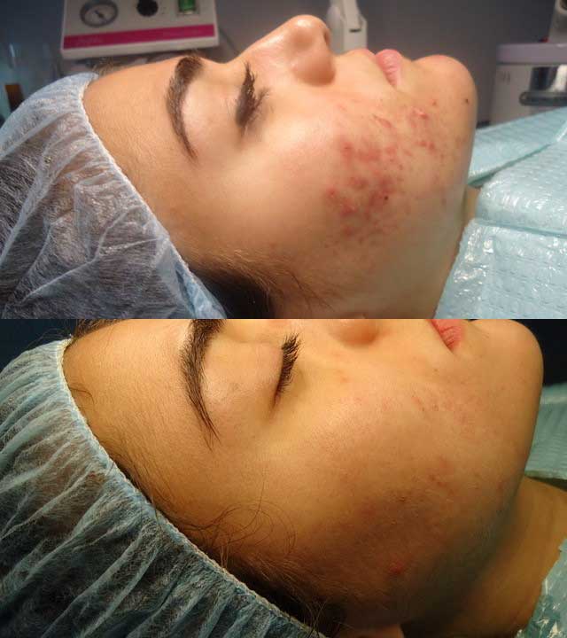 In Skin Before and After Skin Care 01
