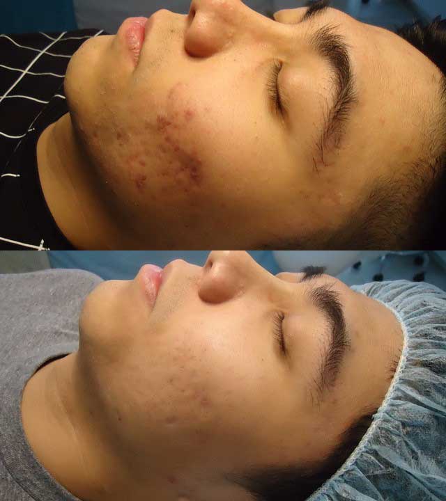 In Skin Before and After Skin Care 03